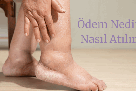 ödem nedir? ödem neden olur? ödem nasıl atılır?