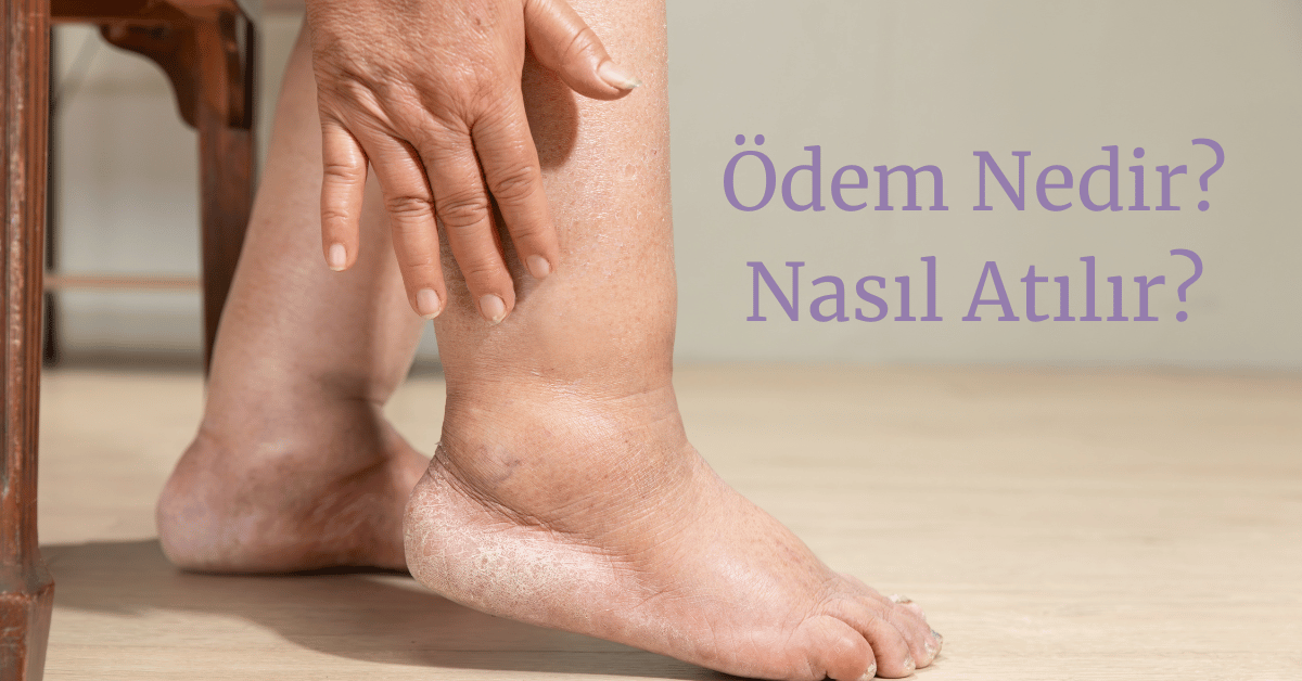 ödem nedir? ödem neden olur? ödem nasıl atılır?