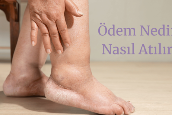 Ödem Nedir? Neden Olur ve Ödem Nasıl Atılır?
